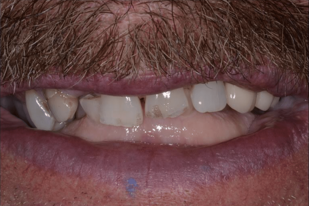 before dental implant restoration
