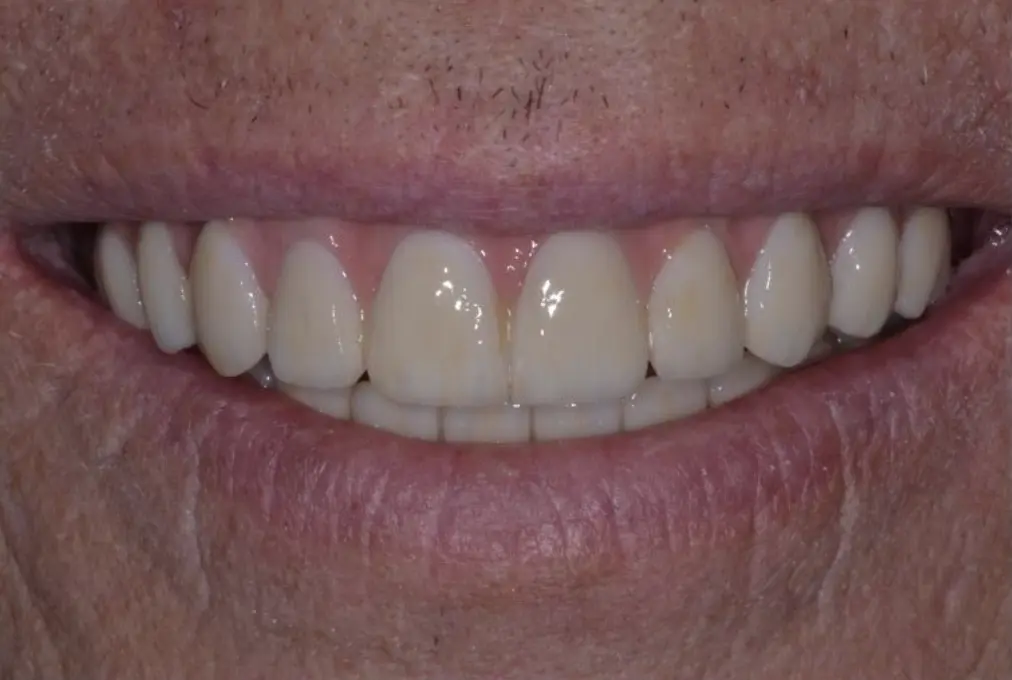 dental implant pictures