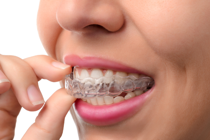 suresmile clear aligners