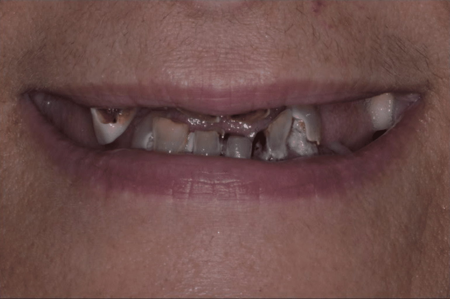 before dental implants