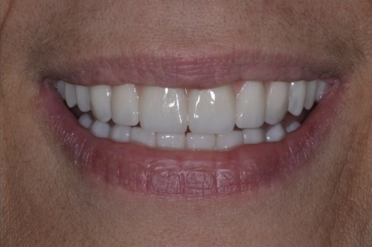 What do dental implants look like