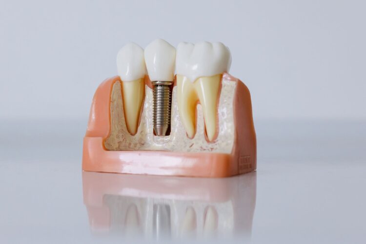 What do dental implants look like