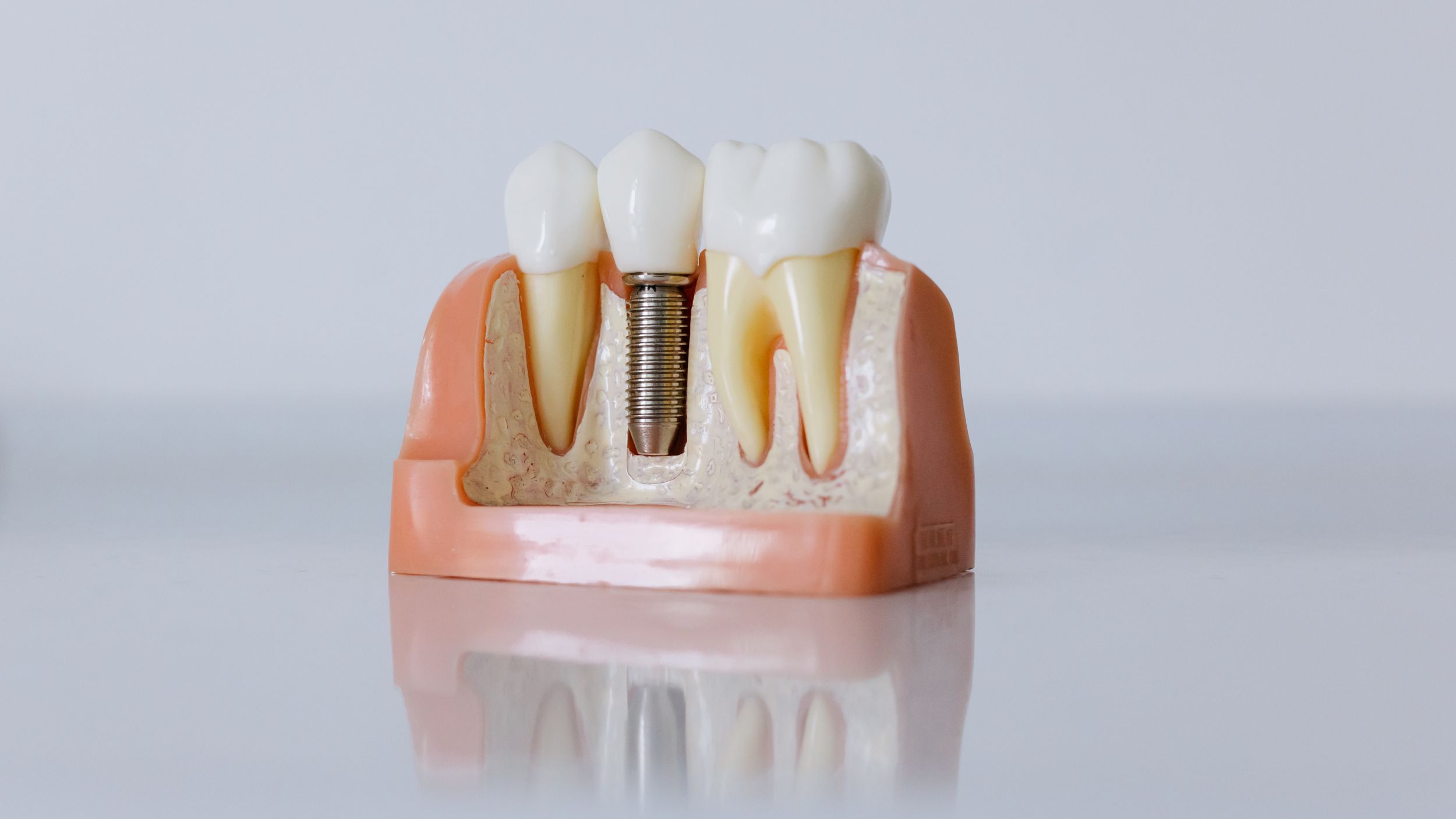 What do dental implants look like